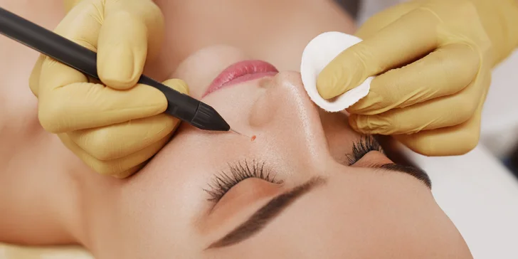 Odstránenie cievnych sietí a metličkových žiliek vysokorádiovou ihlo, RF koagulácia