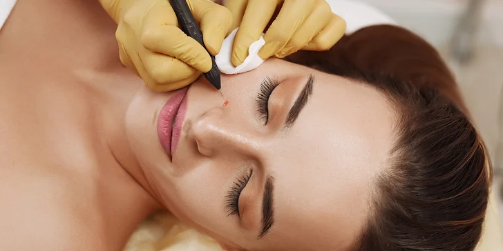 Odstránenie cievnych sietí a metličkových žiliek vysokorádiovou ihlo, RF koagulácia