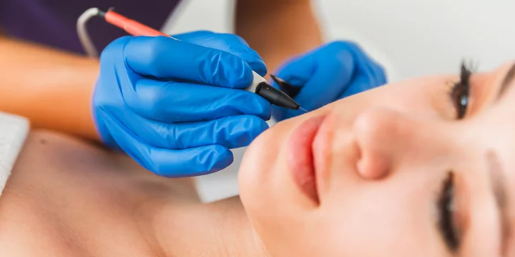 Elektroepilácia: trvalé odstránenie chĺpkov, aj výhodné permanentky