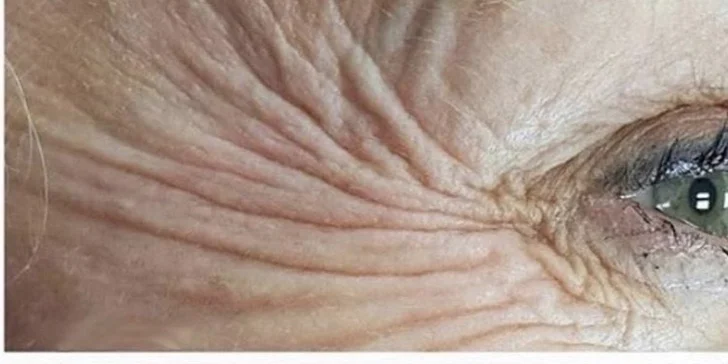 Plazmalift: horné alebo dolné viečka, vrásky okolo očí, celé čelo, nosoústna vráska