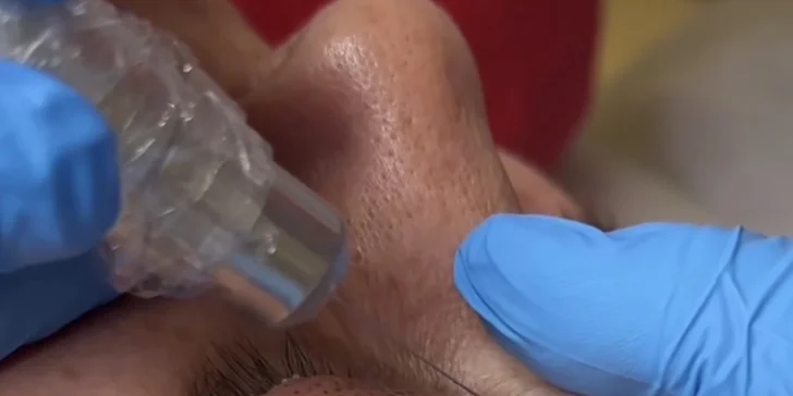 Plazmalift: horné alebo dolné viečka, vrásky okolo očí, celé čelo, nosoústna vráska