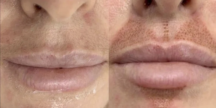 Plazmalift: horné alebo dolné viečka, vrásky okolo očí, celé čelo, nosoústna vráska