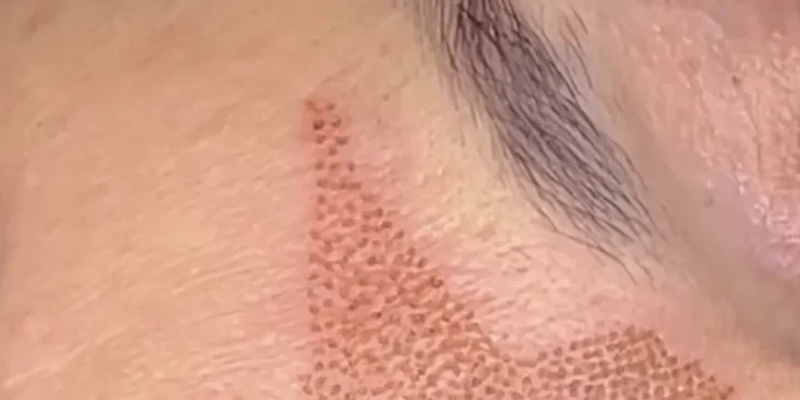 Plazmalift: horné alebo dolné viečka, vrásky okolo očí, celé čelo, nosoústna vráska