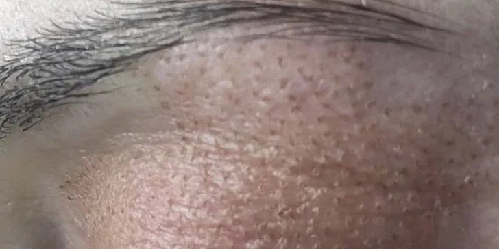 Plazmalift: horné alebo dolné viečka, vrásky okolo očí, celé čelo, nosoústna vráska