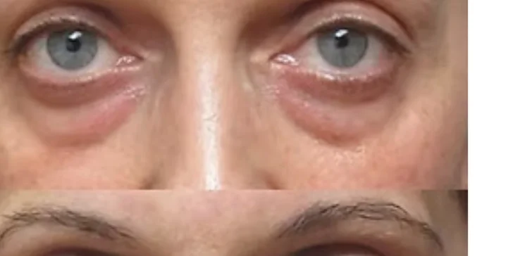 Plazmalift: horné alebo dolné viečka, vrásky okolo očí, celé čelo, nosoústna vráska