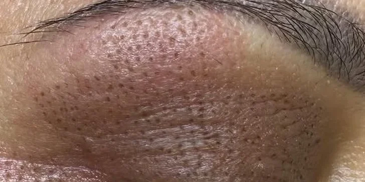 Plazmalift: horné alebo dolné viečka, vrásky okolo očí, celé čelo, nosoústna vráska