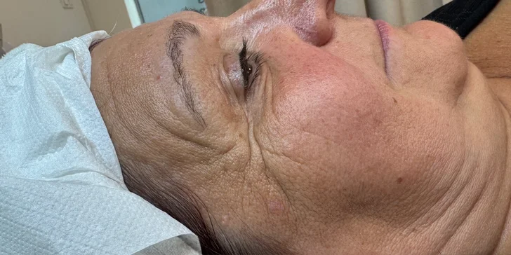 ReHarmony rituálne ošetrenie pleti, BioRePeel či Carbon Peel