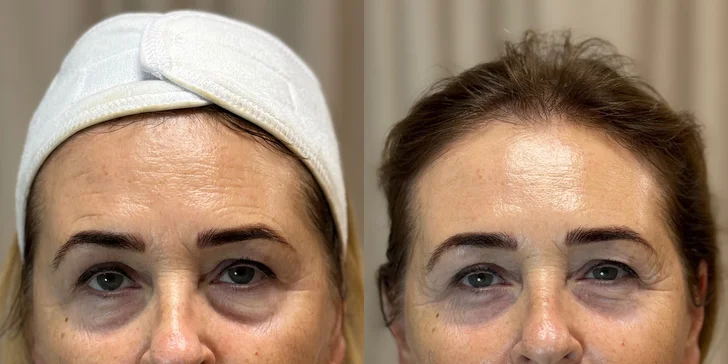 ReHarmony rituálne ošetrenie pleti, BioRePeel či Carbon Peel