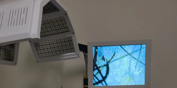 Brilliance Hair Therapy – laserová vlasová terapia novej generácie