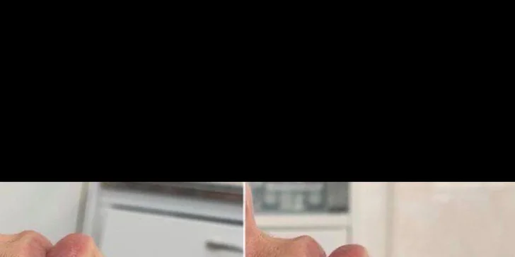 Mezoterapia tváre či pokožky hlavy alebo microneedling na odstránenie jaziev