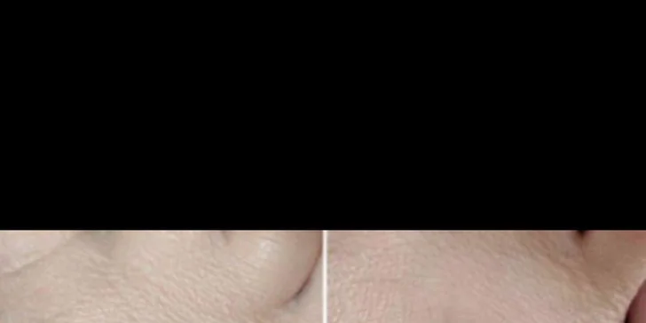 Mezoterapia tváre či pokožky hlavy alebo microneedling na odstránenie jaziev