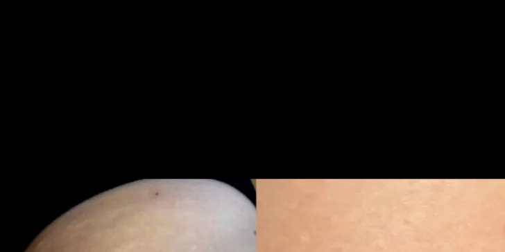 Mezoterapia tváre či pokožky hlavy alebo microneedling na odstránenie jaziev