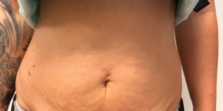 Neinvazívny lifting HIFU 12D na omladenie tváre a spevnenie brucha