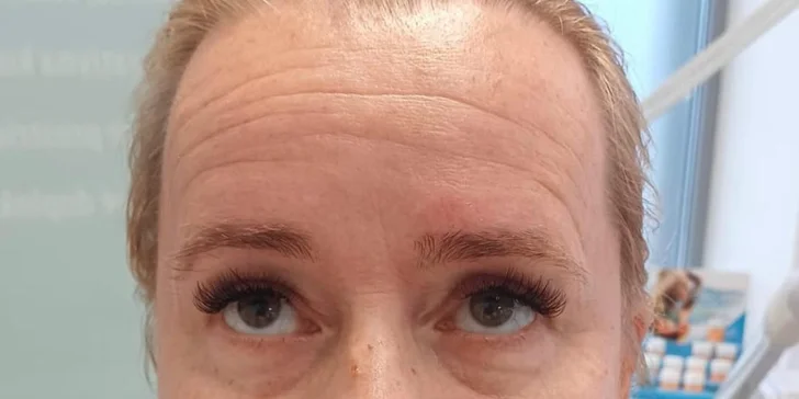 Neinvazívny lifting HIFU 12D na omladenie tváre a spevnenie brucha