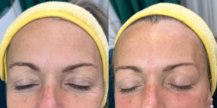 Omladenie bez skalpela: Tréning tvárových svalov a ošetrenie EMS prístrojom, aj permanentka