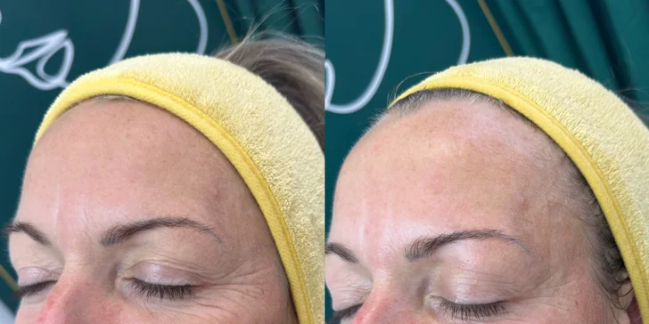 Omladenie bez skalpela: Tréning tvárových svalov a ošetrenie EMS prístrojom, aj permanentka