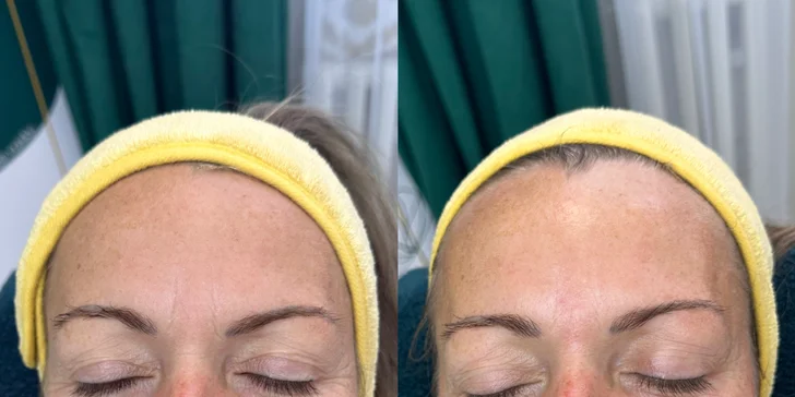 Omladenie bez skalpela: Tréning tvárových svalov a ošetrenie EMS prístrojom, aj permanentka