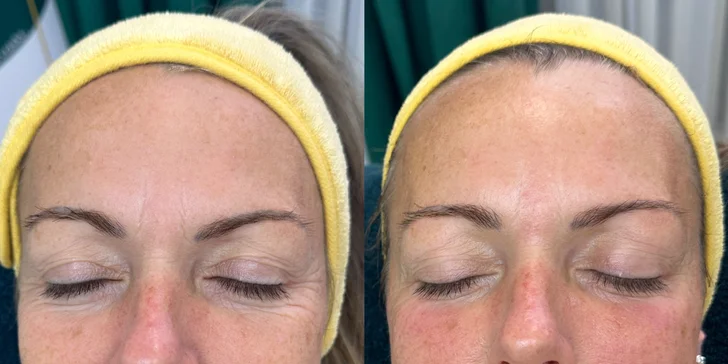 Omladenie bez skalpela: Tréning tvárových svalov a ošetrenie EMS prístrojom, aj permanentka