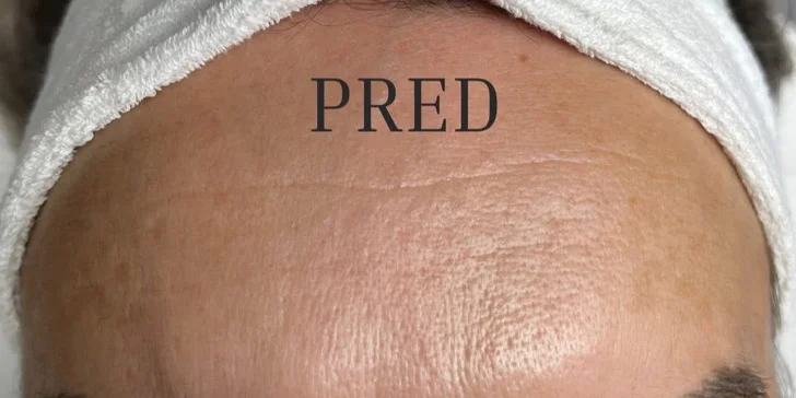 Omladenie bez chirurgického zákroku: HIFU ošetrenie celej tváre a podbradku