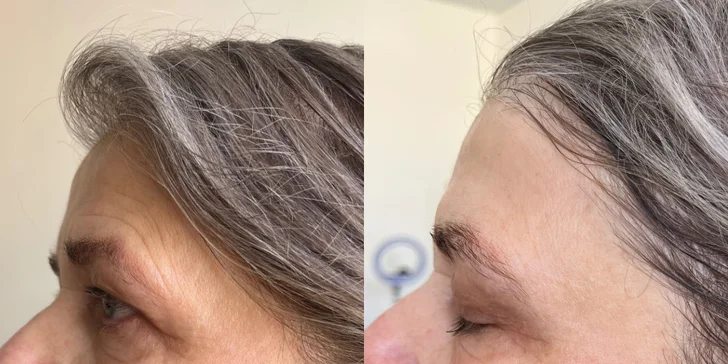 Omladenie bez chirurgického zákroku: HIFU ošetrenie celej tváre a podbradku