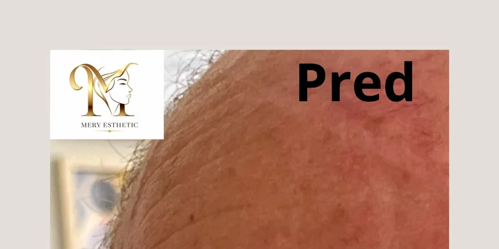 Omladenie bez chirurgického zákroku: HIFU ošetrenie celej tváre a podbradku