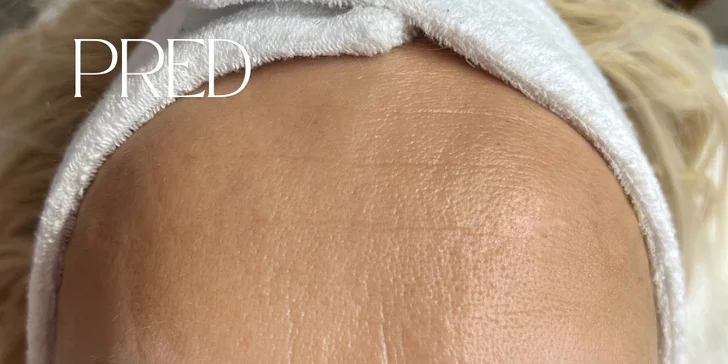 Omladenie bez chirurgického zákroku: HIFU ošetrenie celej tváre a podbradku