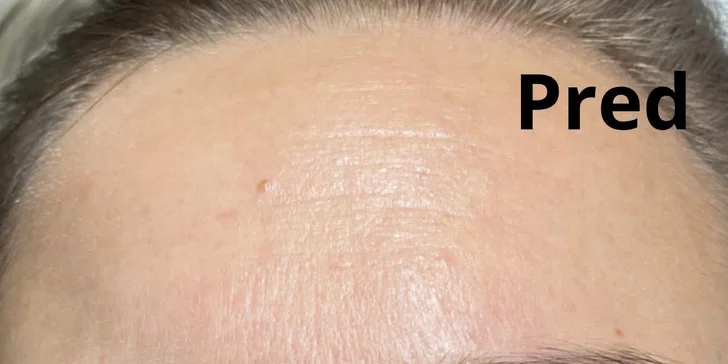 Omladenie bez chirurgického zákroku: HIFU ošetrenie celej tváre a podbradku