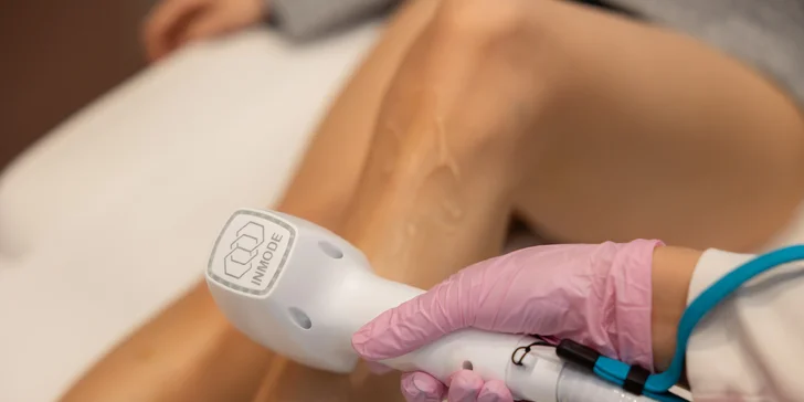 Laserová epilácia pomocou špičkového lasera Triton: horná pera, podpazušie, predkolenie, bikiny a iné