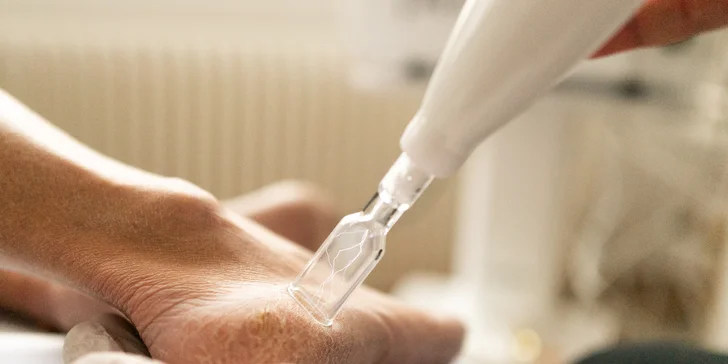 Plazma Fusion: zbavte sa jaziev, vrások alebo podporte rast vlasov a zregenerujte pleť