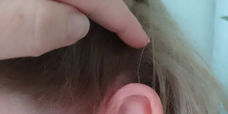 Plazma Fusion: zbavte sa jaziev, vrások alebo podporte rast vlasov a zregenerujte pleť