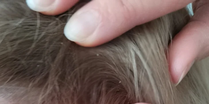 Plazma Fusion: zbavte sa jaziev, vrások alebo podporte rast vlasov a zregenerujte pleť