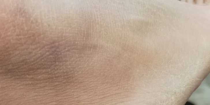 Plazma Fusion: zbavte sa jaziev, vrások alebo podporte rast vlasov a zregenerujte pleť