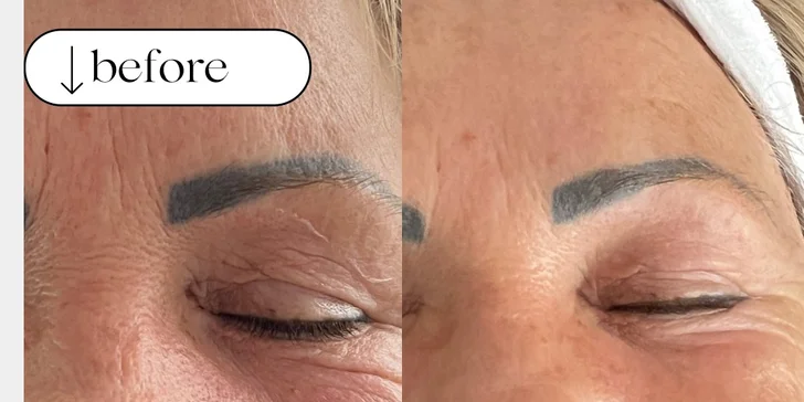 Omladenie bez chirurgického zákroku: HIFU ošetrenie celej tváre a podbradku