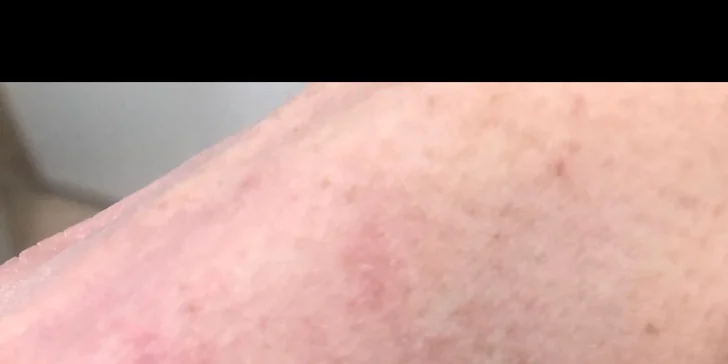 Plazma Fusion: zbavte sa jaziev, vrások alebo podporte rast vlasov a zregenerujte pleť