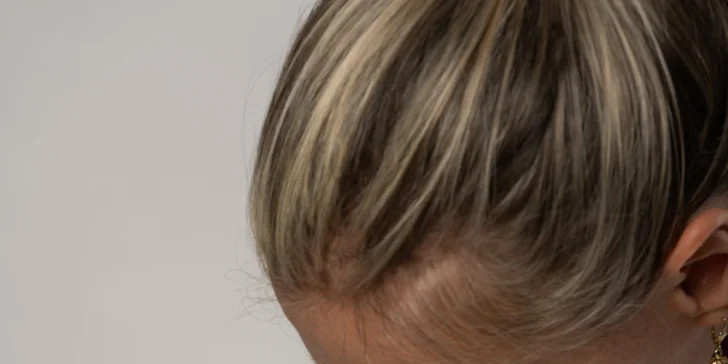 Aplikácia botulotoxínu: vráska hnevu, čelo, kútiky úst a iné