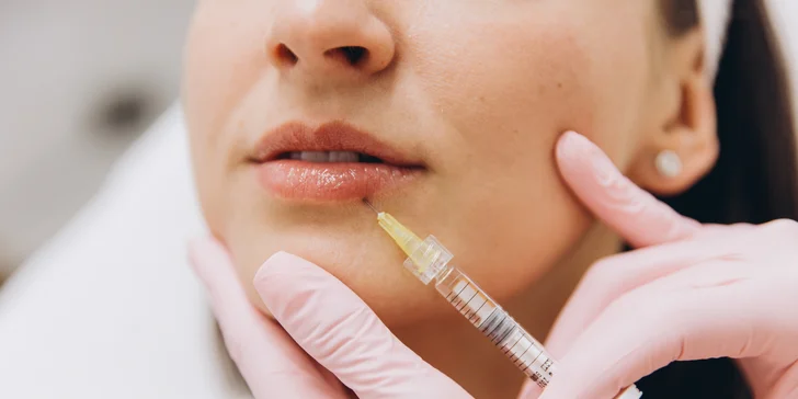 Výplň a modelácia pier kyselinou hyalurónovou: prirodzene tvarované a hydratované pery