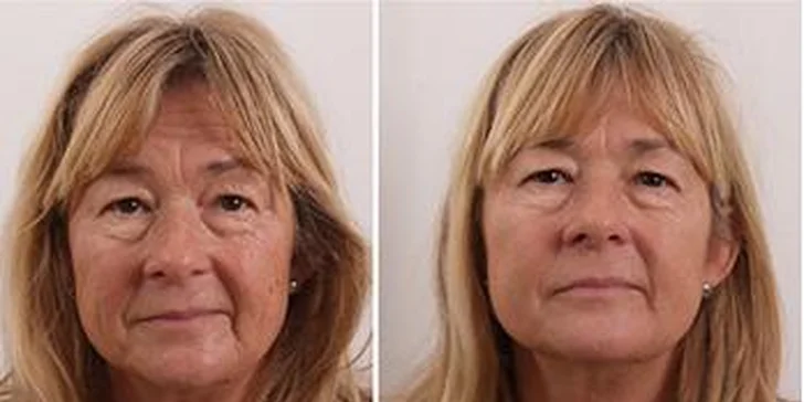 Svetová revolučná novinka v estetickej medicíne - plazmové toky len v Musculus