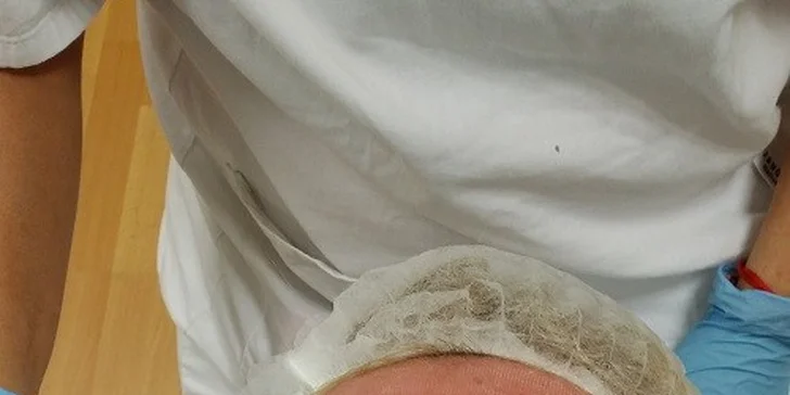 Frakčný resurfacing pre omladenie pleti