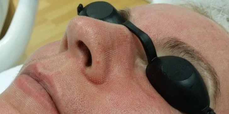 Frakčný resurfacing pre omladenie pleti