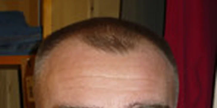 BOTOX - korekcia vrások v Medicínskom centre Niobé
