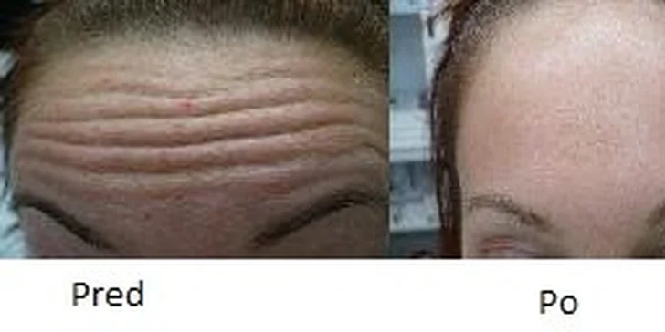 BOTOX - korekcia vrások v Medicínskom centre Niobé