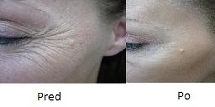 BOTOX - korekcia vrások v Medicínskom centre Niobé