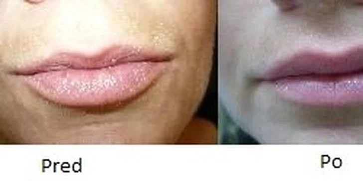 BOTOX - korekcia vrások v Medicínskom centre Niobé