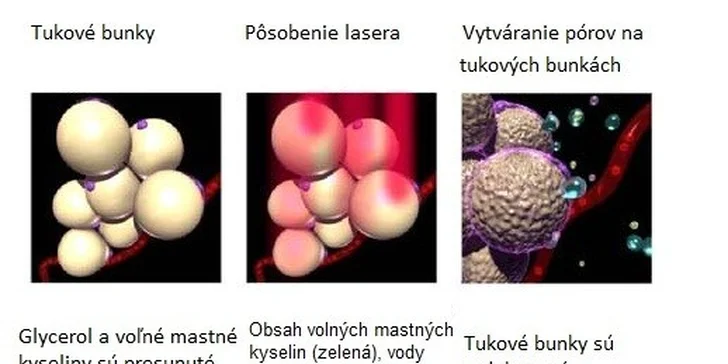 Medicínska liposukcia - LIPOLASEROM