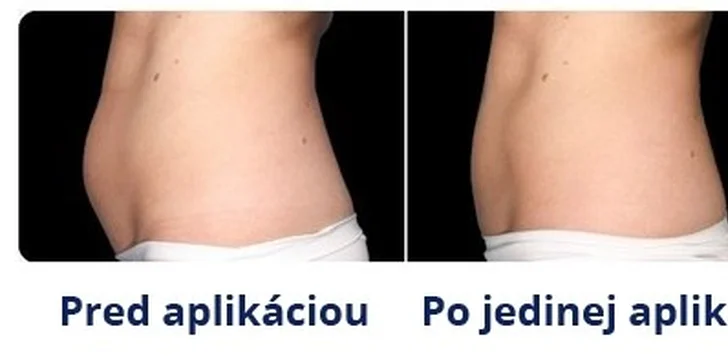 Kryolipolýza a vstupy na 3D vibračnú plošinu