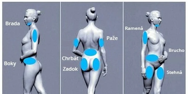 Kryolipolýza a vstupy na 3D vibračnú plošinu