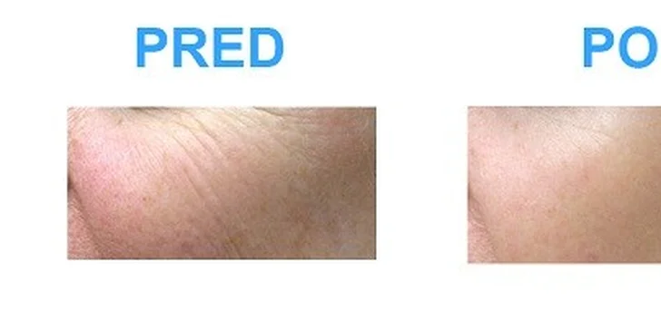 Omladenie pleti v centre plastickej chirurgie