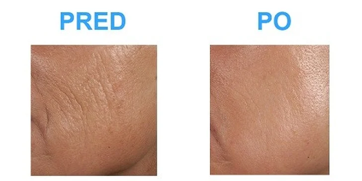 Omladenie pleti v centre plastickej chirurgie