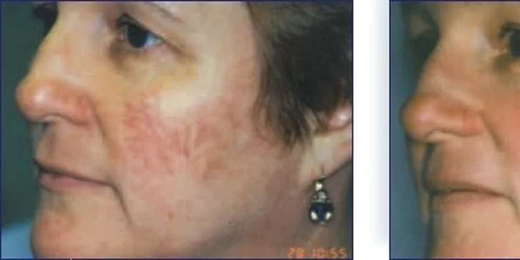 Krásna a svieža pleť s 4D fotorejuvenizáciou