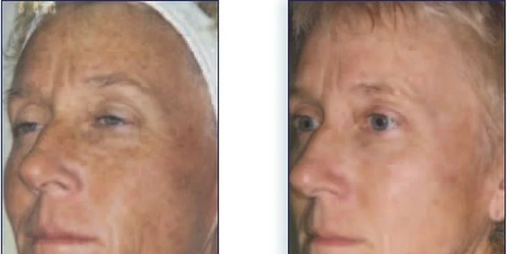 Krásna a svieža pleť s 4D fotorejuvenizáciou